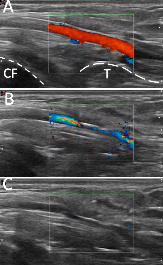 Síndrome d'atrapament de l'artèria poplítea per compressió (SAPF o tipus 6). Estudi ecogràfic, nivell P3. A: estudi ecogràfic basal. B i C: Progressiva oclusió arterial durant la contracció muscular. CF: còndil femoral, T: vora tibial posterior proximal.