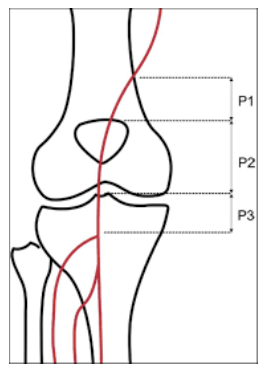 Niveles de estudio eco Doppler de la arteria poplitea P1: supracondíleo; P2: intercondíleo; P3: Infracondíleo
